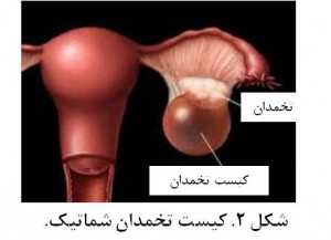 Ovarian cyst fig 2