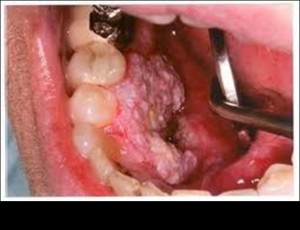 HPV-Oral Cancer Fig 5