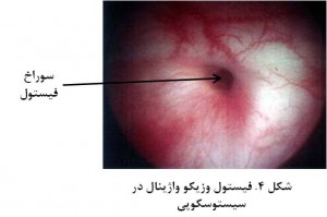 Vesicovaginal fistula fig 4