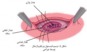 Vesicovaginal fistula fig 5