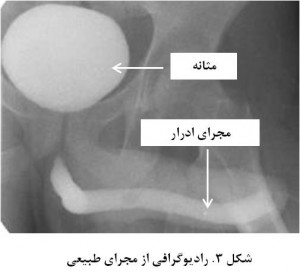 Urethral stricture in men fig 3