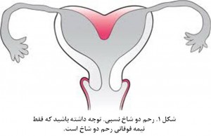 Bicornuate uterus fig 1