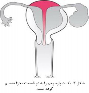 Bicornuate uterus fig 3