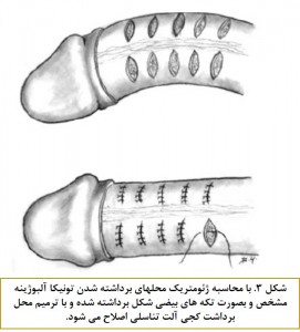 Surgical techniques for congenital penile curvature fig 3